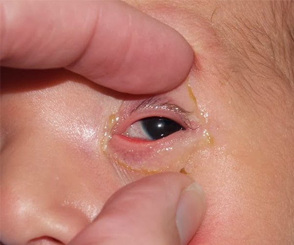bệnh về mắt bé sơ sinh